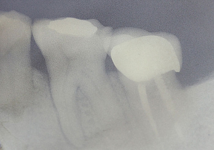 X-Ray of tooth demonstrating lesion around mesial root