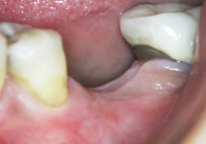 Extraction site two months later