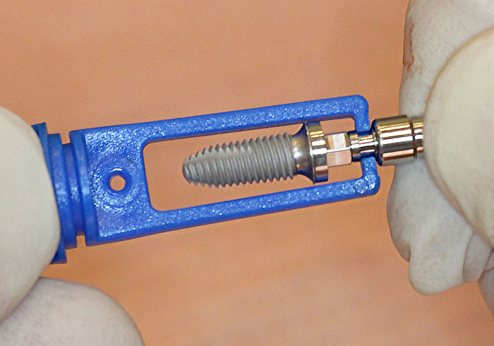 TFR-W 5-13 implant
