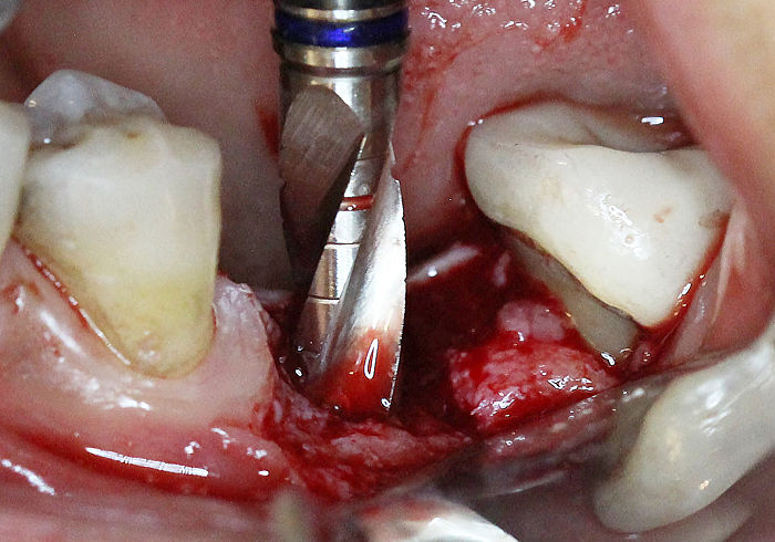 4.2mm Final bur