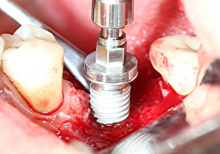 Inserting implant