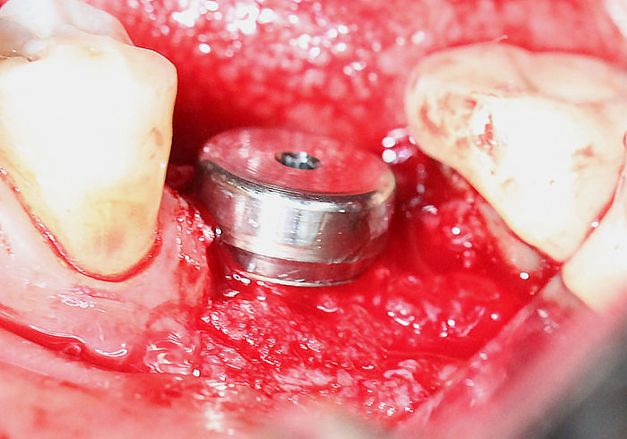 Bone augmentation and 1.5 mm Healing cap