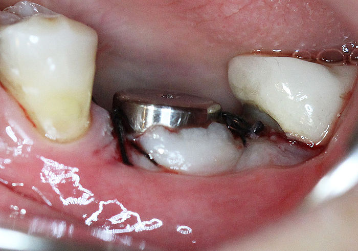 Sutures around healing cap