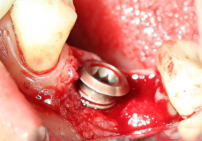 Buccal bone defect 2 threads