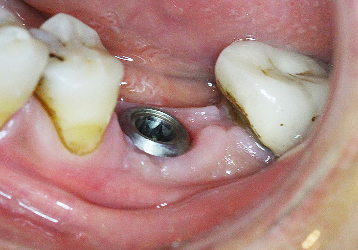 After removing Healing cap