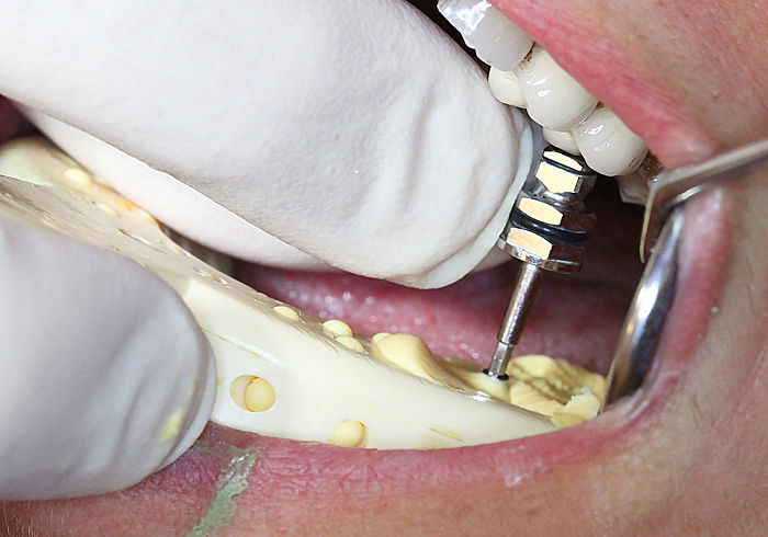 Taking Open Tray impression