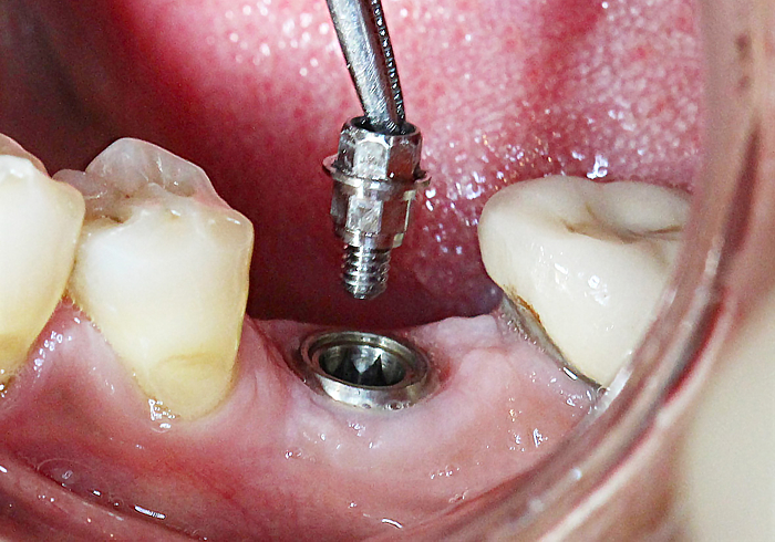 Placing Abutment