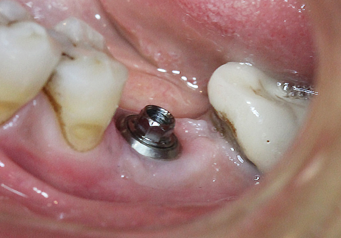 Abutment for screw retained crown