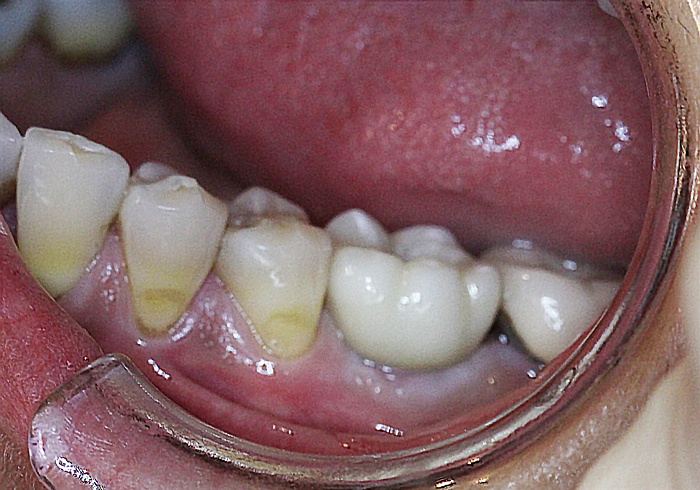 Final restoration
